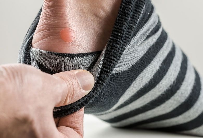 Vesciche ai piedi